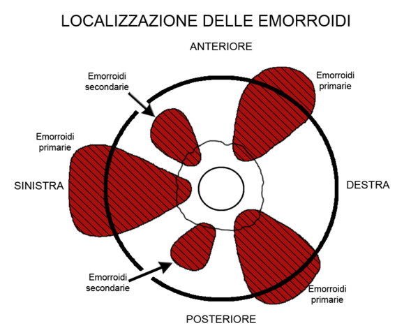 Localizzazione Emorroidi